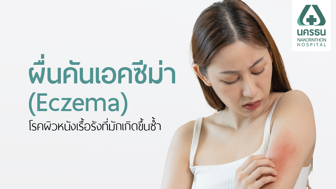 โรคผื่นภูมิแพ้ผิวหนังชนิดเอคซิม่า (Eczema) กับการรักษาให้ถูกวิธี